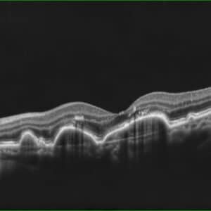 De belangrijkste oogaandoeningen: maculadegeneratie, glaucoom en diabetische retinopathie OCT retina netvlies lagen MD
